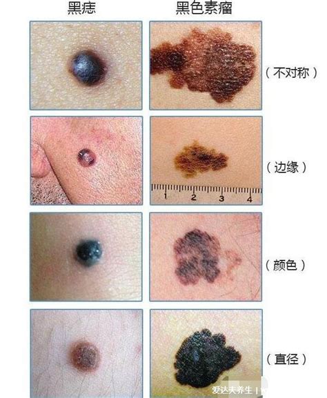 臉部痣|是痣還是瘤？黑色素瘤的類型、症狀與治療